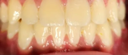 Crowded Teeth and Overjet treated with braces after orthodontic treatment at Elate Orthodontics, case 3598