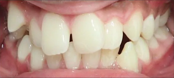 Crowded Teeth and Overjet treated with braces before orthodontic treatment at Elate Orthodontics, case 3598