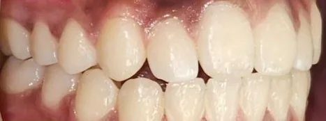 Crowded Teeth and Overjet treated with braces after orthodontic treatment at Elate Orthodontics, case 4002