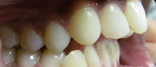 Crowded Teeth and Overjet treated with braces before orthodontic treatment at Elate Orthodontics, case 4002