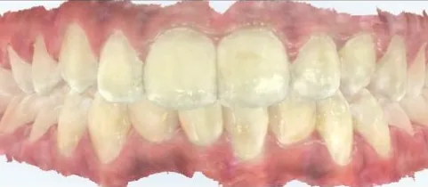 Crowded Teeth and Underbite treated with clear aligners after orthodontic treatment at Elate Orthodontics, case 3812