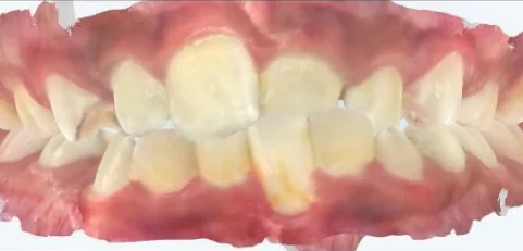 Crowded Teeth and Underbite treated with clear aligners before orthodontic treatment at Elate Orthodontics, case 3812