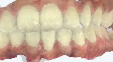 Crowded Teeth, Underbite and Crossbite treated with expander and braces after orthodontic treatment at Elate Orthodontics, case 3876