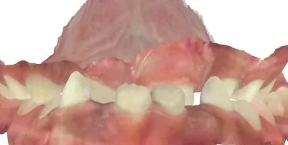 Crowded Teeth, Underbite and Crossbite treated with expander and braces before orthodontic treatment at Elate Orthodontics, case 3876
