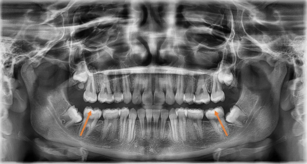 Impacted Teeth and Crowded Teeth after orthodontic treatment at Elate Orthodontics, case 3516