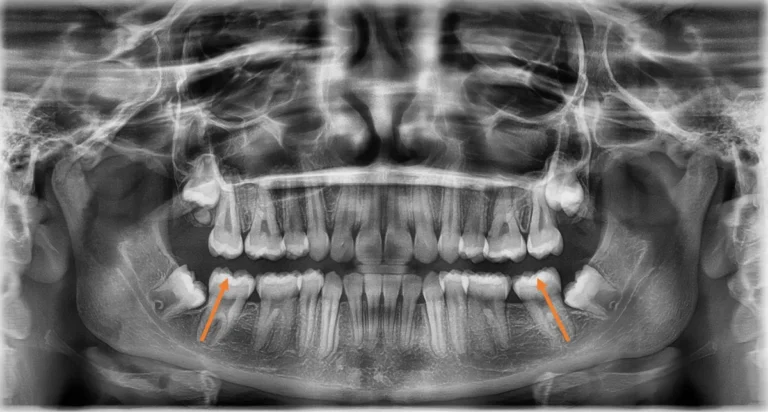 Impacted Teeth and Crowded Teeth after orthodontic treatment at Elate Orthodontics, case 3516