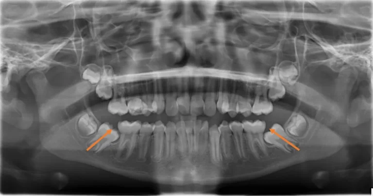 Impacted Teeth and Crowded Teeth before orthodontic treatment at Elate Orthodontics, case 3516