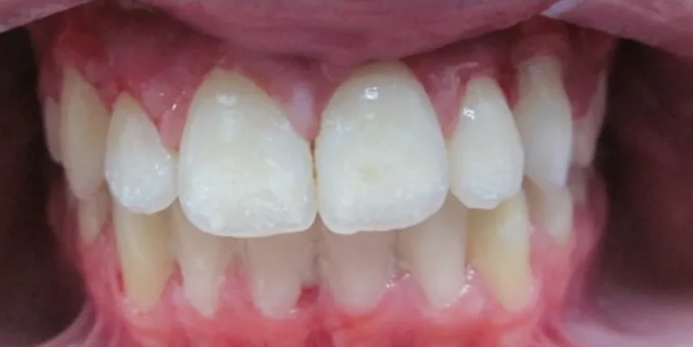 Impacted Teeth, Overbite and Crowded Teeth after orthodontic treatment at Elate Orthodontics, case 3474