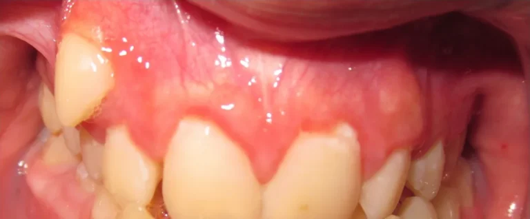 Impacted Teeth, Overbite and Crowded Teeth before orthodontic treatment at Elate Orthodontics, case 3474