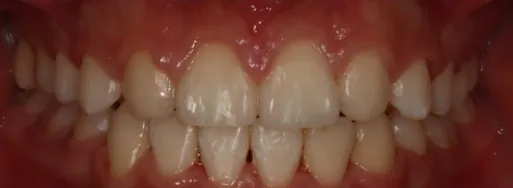 Missing Teeth treated with braces after orthodontic treatment at Elate Orthodontics, case 3852