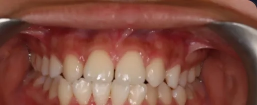 Missing Teeth treated with braces before orthodontic treatment at Elate Orthodontics, case 3852