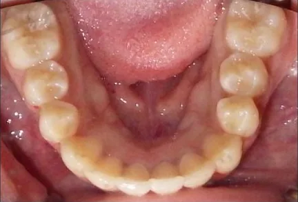 Narrow Palate, Crowded Teeth and Overbite treated with clear aligners after orthodontic treatment at Elate Orthodontics, case 3756