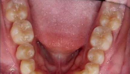 Narrow Palate, Crowded Teeth and Overbite treated with clear aligners before orthodontic treatment at Elate Orthodontics, case 3756