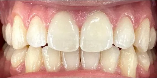 Narrow Palate and Crowded Teeth treated with clear aligners after orthodontic treatment at Elate Orthodontics, case 3816
