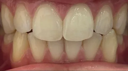 Narrow Palate and Crowded Teeth treated with clear aligners before orthodontic treatment at Elate Orthodontics, case 3816