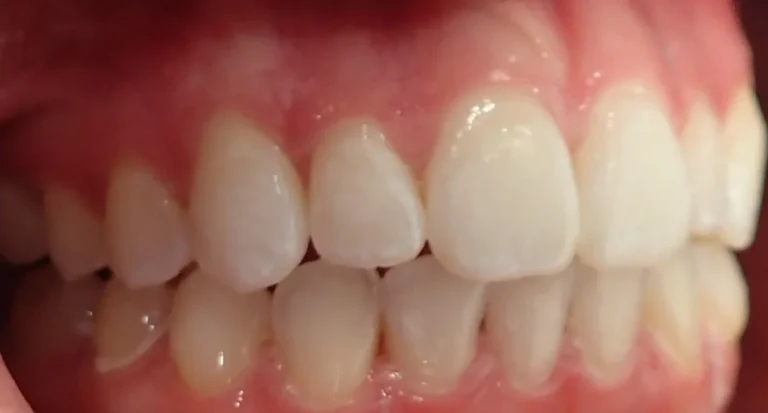 Open Bite treated with clear aligners after orthodontic treatment at Elate Orthodontics, case 3486