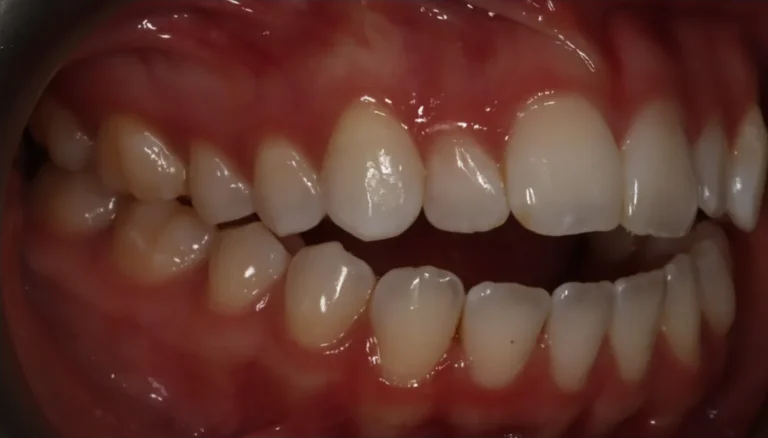 Open Bite treated with clear aligners before orthodontic treatment at Elate Orthodontics, case 3486
