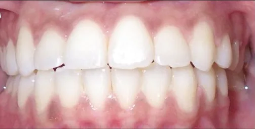 Open Bite treated with braces after orthodontic treatment at Elate Orthodontics, case 3644