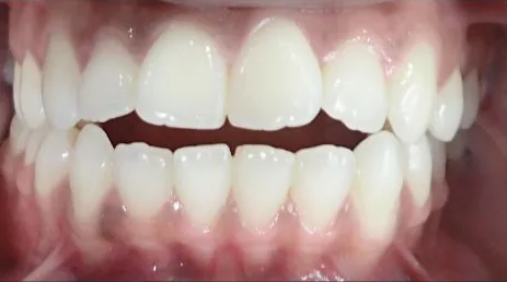 Open Bite treated with braces before orthodontic treatment at Elate Orthodontics, case 3644