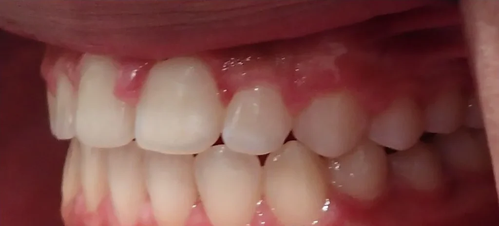 Open Bite and Crossbite treated with expander and braces after orthodontic treatment at Elate Orthodontics, case 3502