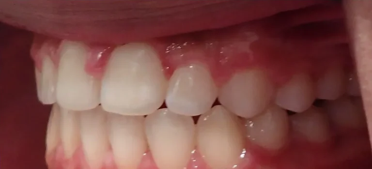 Open Bite and Crossbite treated with expander and braces after orthodontic treatment at Elate Orthodontics, case 3502