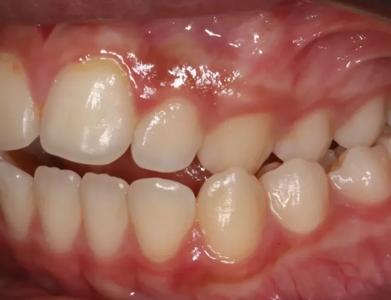Open Bite and Crossbite treated with expander and braces before orthodontic treatment at Elate Orthodontics, case 3502