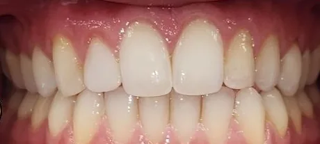 Open Bite and Crowded Teeth treated with clear aligners after orthodontic treatment at Elate Orthodontics, case 3546