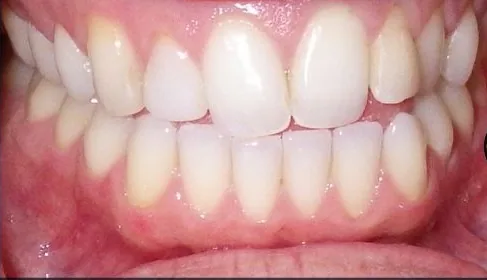 Open Bite and Crowded Teeth treated with clear aligners before orthodontic treatment at Elate Orthodontics, case 3546
