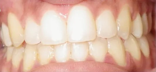 Open Bite and Crowded Teeth treated with braces after orthodontic treatment at Elate Orthodontics, case 3566