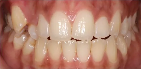 Open Bite and Crowded Teeth treated with braces before orthodontic treatment at Elate Orthodontics, case 3566