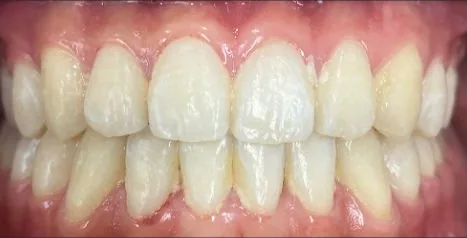 Open Bite and Crowded Teeth treated with braces and expander after orthodontic treatment at Elate Orthodontics, case 3714