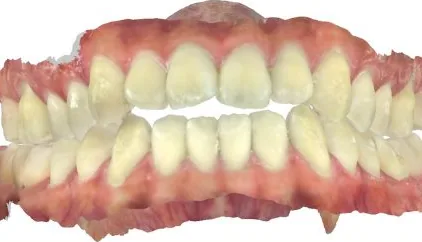 Open Bite and Crowded Teeth treated with braces and expander before orthodontic treatment at Elate Orthodontics, case 3714