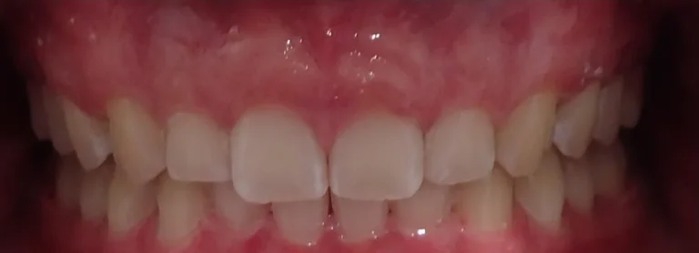 Overbite treated with clear aligners after orthodontic treatment at Elate Orthodontics, case 3494