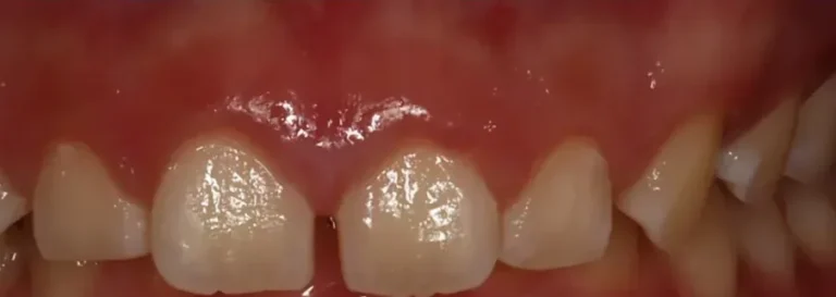 Overbite treated with clear aligners before orthodontic treatment at Elate Orthodontics, case 3494