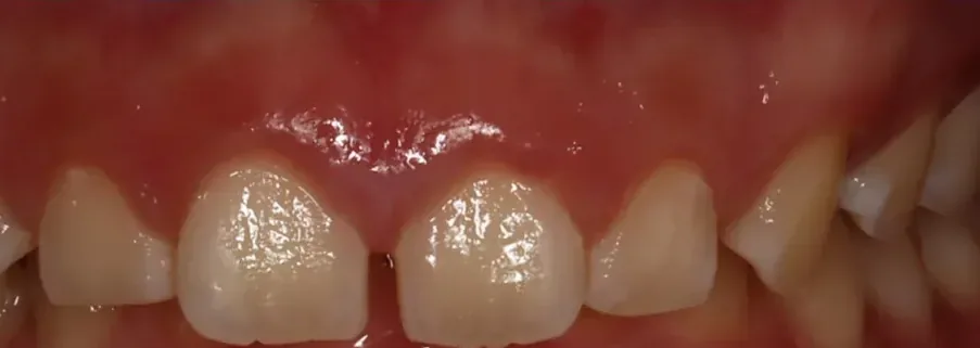 Overbite treated with clear aligners before orthodontic treatment at Elate Orthodontics, case 3494