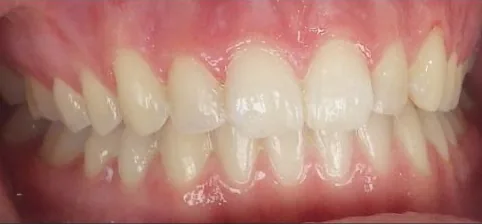 Overbite treated with clear aligners after orthodontic treatment at Elate Orthodontics, case 3614