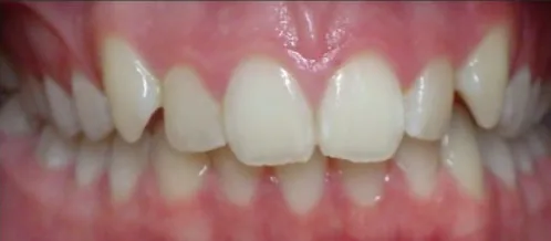 Overbite treated with clear aligners before orthodontic treatment at Elate Orthodontics, case 3614