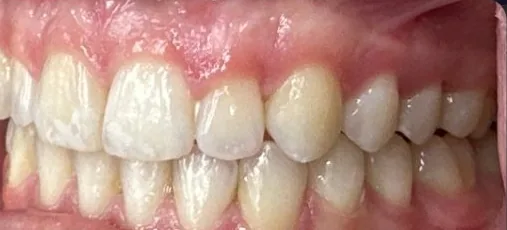 Overbite treated with clear aligners after orthodontic treatment at Elate Orthodontics, case 3928