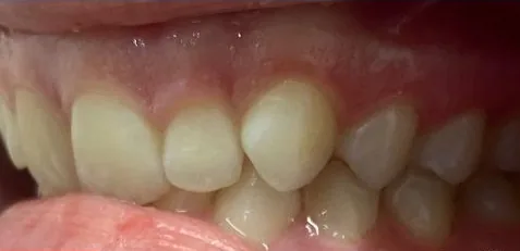 Overbite treated with clear aligners before orthodontic treatment at Elate Orthodontics, case 3928
