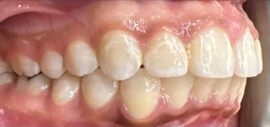 Overbite treated with braces after orthodontic treatment at Elate Orthodontics, case 3936
