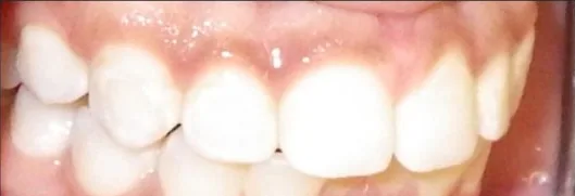 Overbite treated with braces before orthodontic treatment at Elate Orthodontics, case 3936