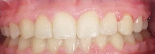 Overbite, Crossbite and Crowded Teeth treated with braces after orthodontic treatment at Elate Orthodontics, case 3570