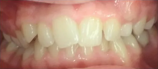 Overbite, Crossbite and Crowded Teeth treated with braces before orthodontic treatment at Elate Orthodontics, case 3570