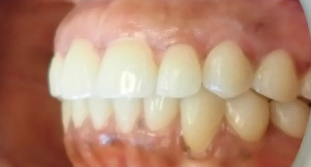 Overbite and Crowded Teeth treated with clear aligners after orthodontic treatment at Elate Orthodontics, case 3512