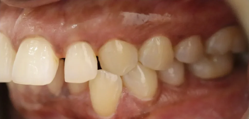 Overbite and Crowded Teeth treated with clear aligners before orthodontic treatment at Elate Orthodontics, case 3512