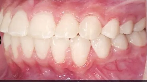 Overbite, Crowded Teeth and Overjet treated with braces after orthodontic treatment at Elate Orthodontics, case 3542