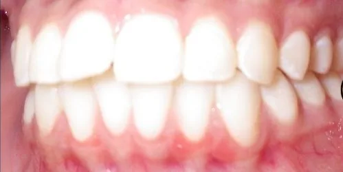 Overbite, Crowded Teeth and Overjet treated with braces before orthodontic treatment at Elate Orthodontics, case 3542