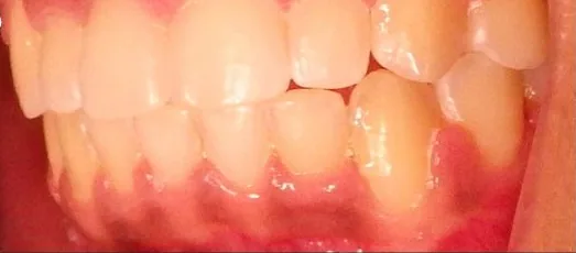 Overbite and Crowded Teeth treated with braces after orthodontic treatment at Elate Orthodontics, case 3586