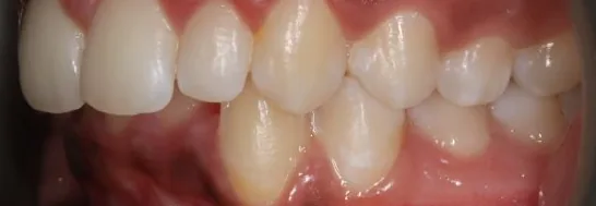 Overbite and Crowded Teeth treated with braces before orthodontic treatment at Elate Orthodontics, case 3586