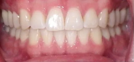 Overbite and Crowded Teeth treated with clear aligners after orthodontic treatment at Elate Orthodontics, case 3698